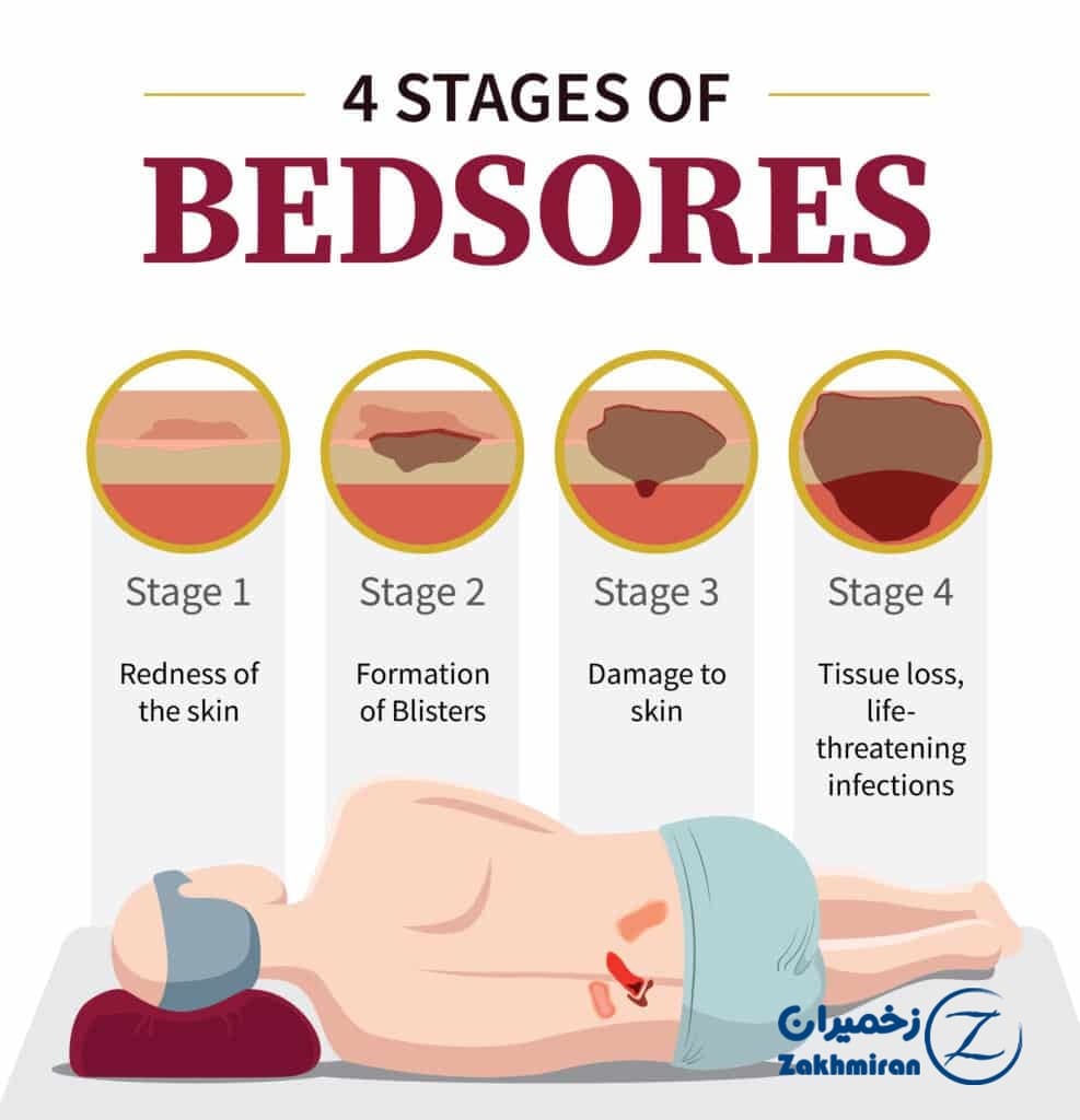 درمان زخم بستر 3 درمان زخم بستر
