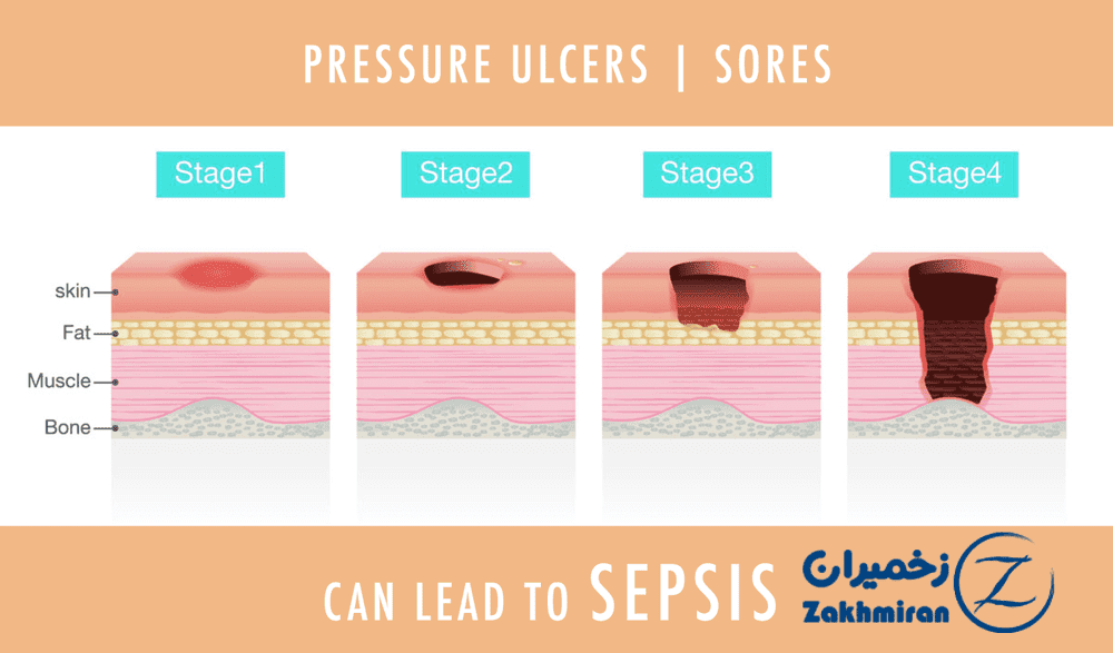 درمان زخم بستر 2 درمان زخم بستر
