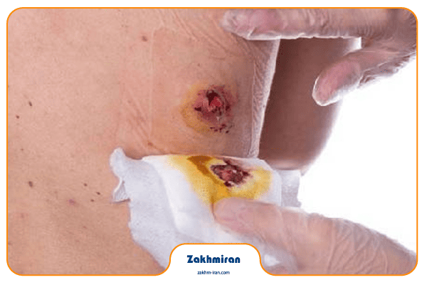 درمان عفونت زخم 2 نشانههای خطرناک عفونت زخم