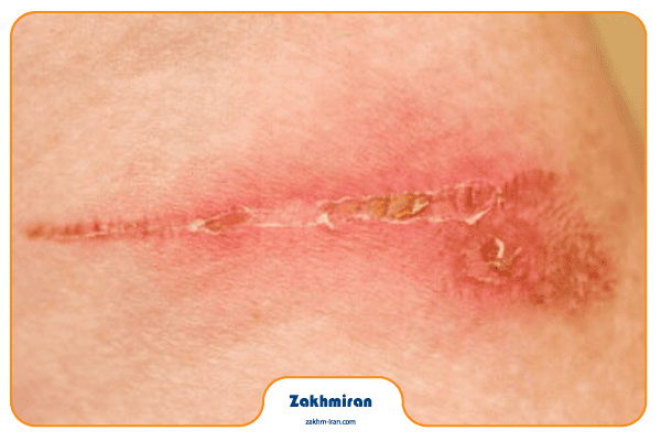 درمان عفونت زخم 3 نشانههای خطرناک عفونت زخم