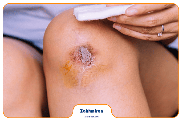 درمان عفونت زخم 4 چگونه ترشحات عفونی زخم را کنترل کنیم؟