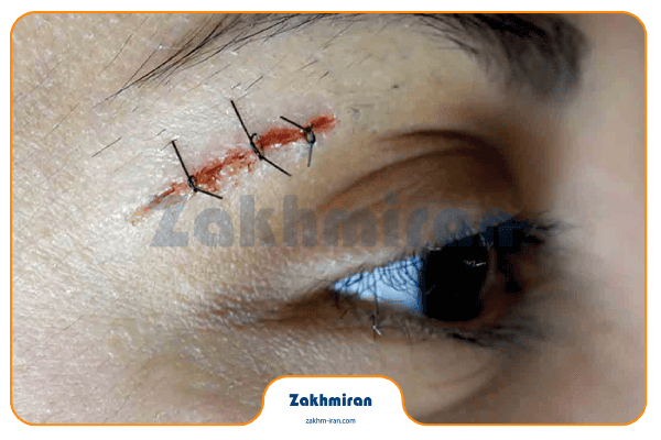 بخیه 2 انواع بخیه و مراقبت ها و موارد مهم در بخیه که باید رعایت شوند