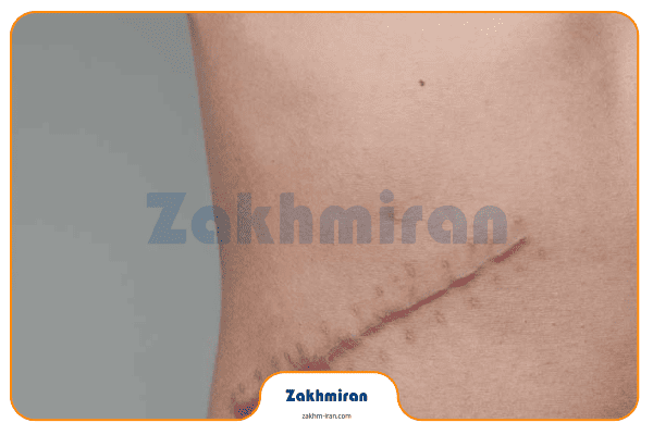 بخیه 3 بخیه زدن و کشیدن بخیه در منزل