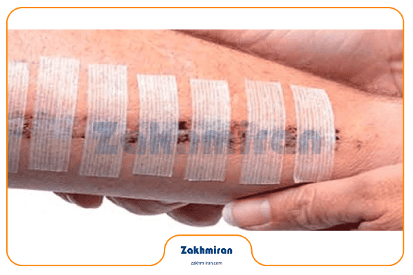 بخیه 4 راهنمای مراقبت از زخم بخیه