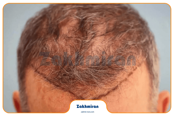 زخم پوست سر نشانه چیست؟ بررسی علل + راه‌های پیشگیری