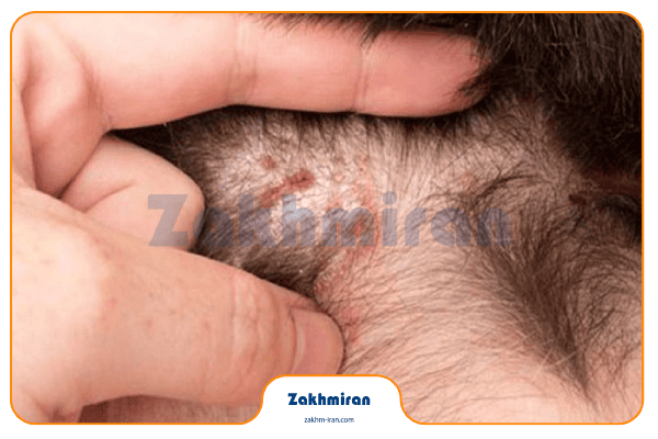 زخم کف سر 4 علت و درمان زخم و پوسته پوسته شدن سر