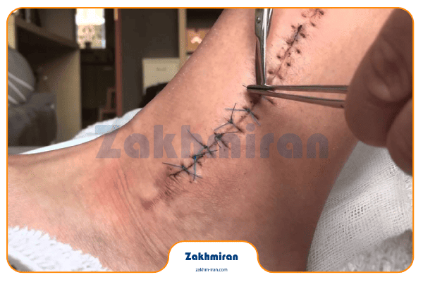 مراقبت از بخیه‌ها در منزل و نکات قابل توجه آن