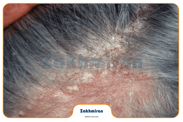 زخم کف سر 2 مشکلات پوستی در زخم شدن کف سر