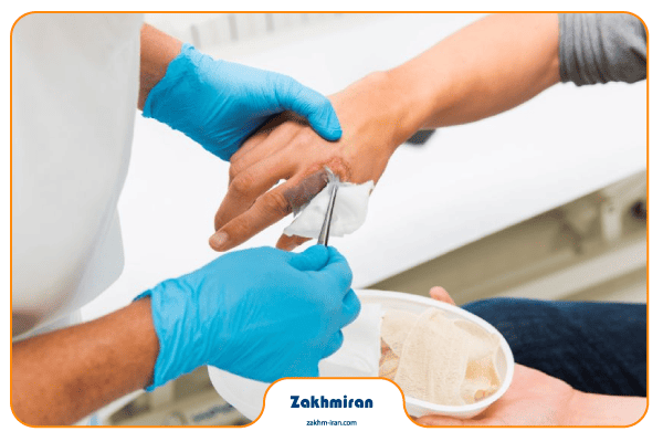 دبرید کردن زخم 5 دبرید کردن زخم سوختگی