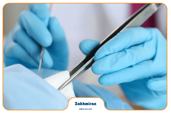 دبرید کردن زخم 2 چه زمانی دبرید کردن زخم لازم است؟