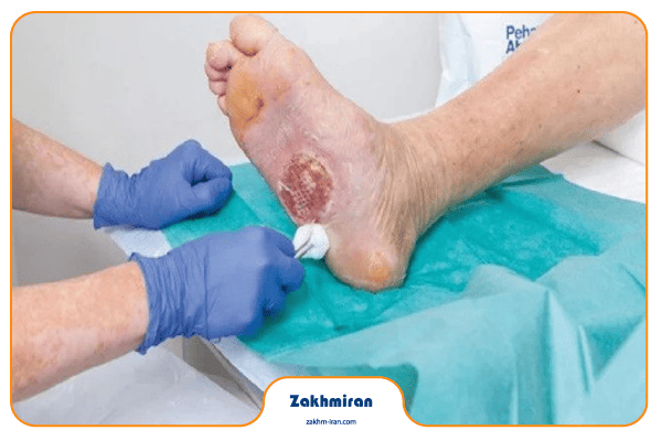 دبرید کردن زخم 3 دبرید کردن زخم دیابتی