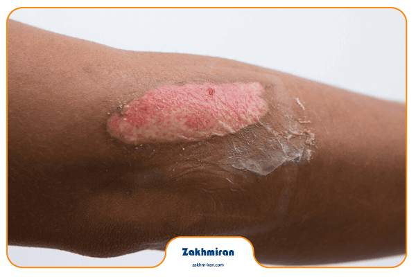 دبرید کردن زخم 6 آیا دبرید کردن زخم دردناک است؟