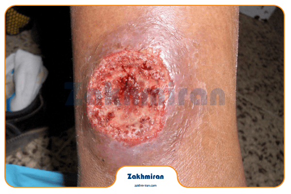 بیماری سالک 10 پیشگیری از بیماری سالک