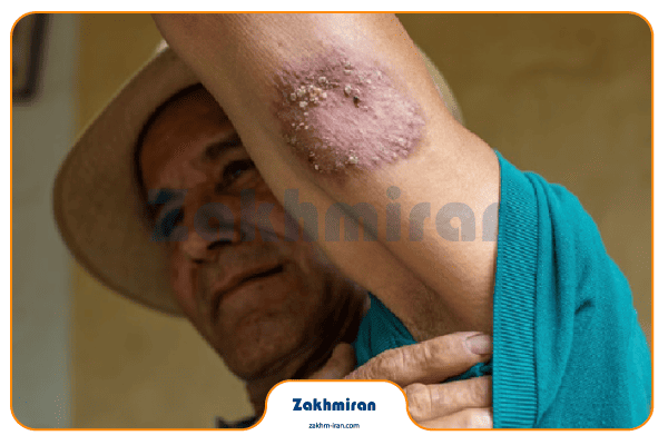 بیماری سالک 3 درمان بیماری سالک