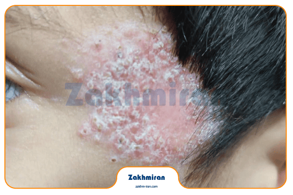 بیماری سالک 7 پشه سالک چیست