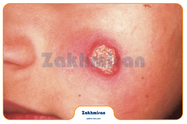 بیماری سالک 8 نیش پشه سالک