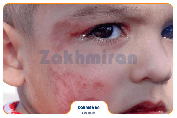 بیماری سالک 9 ضد عفونی سالک در خانه