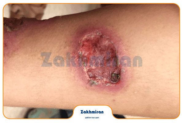 بیماری سالک 4 انواع سالک