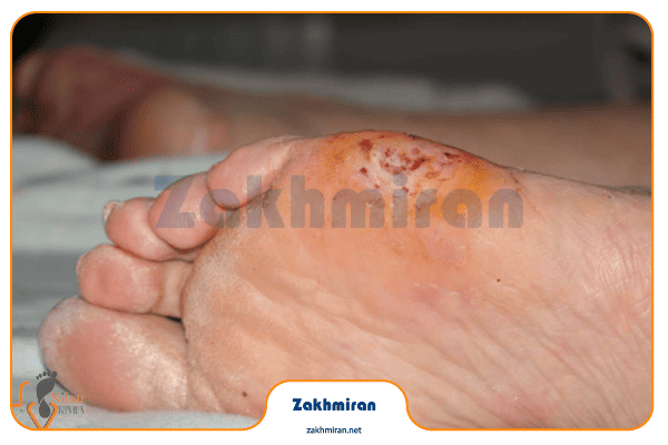زخم پای دیابتی 2 تشخیص زخم پای دیابتی