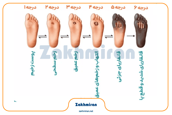 جدیدترین تکنولوژی‌های درمان زخم پای دیابتی