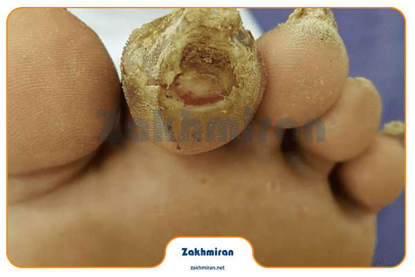 زخم پای دیابتی 3 درمان زخم پای دیابتی