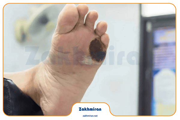 زخم پای دیابتی 10 زخم پای دیابتی چه نوع زخمیه؟