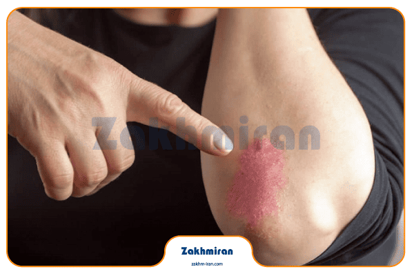 بیماری سالک 2 بیماری سالک چیست