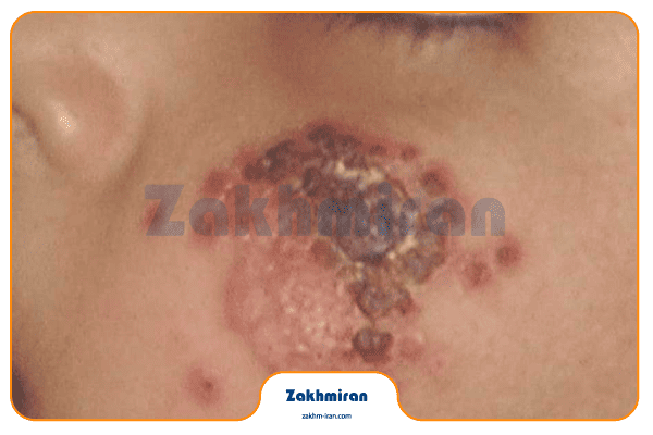 بیماری سالک 5 علائم بیماری سالک