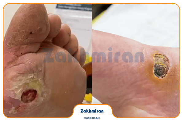 زخم پای دیابتی 4 علل ایجاد زخم پای دیابتی