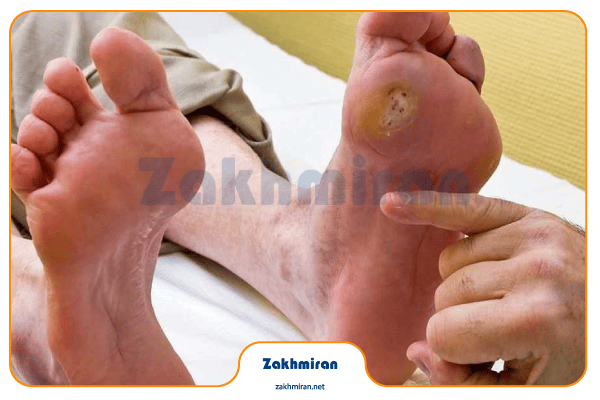 مرحله‌بندی زخم پای دیابتی (طبقه‌بندی واگنر)