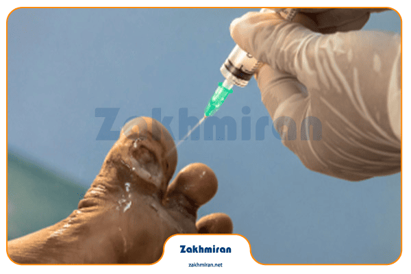 زخم پای دیابتی 8 پیشگیری از زخم پای دیابتی