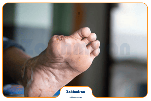 چرا زخم پای دیابتی بوی بد می‌دهد؟