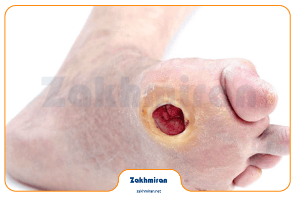 چرا زخم پای دیابتی خوب نمی‌شود؟