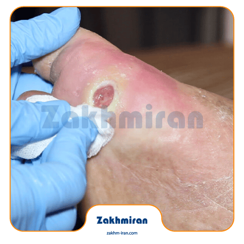 درمان عفونت زخم