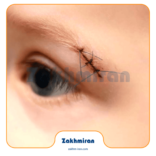 بخیه چیست؟معرفی و آموزش 6 نوع بخیه