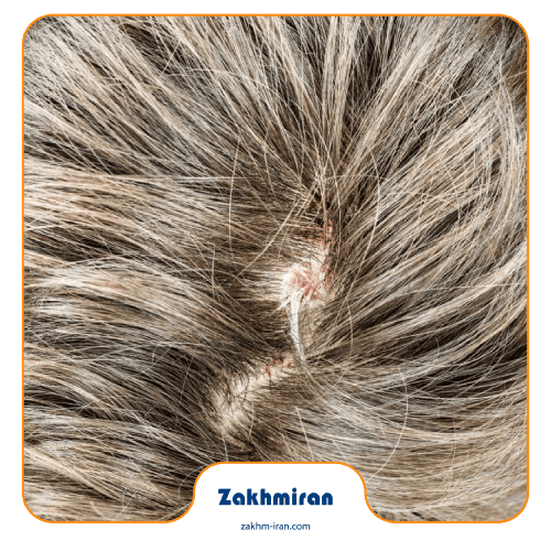 زخم شدن کف سر