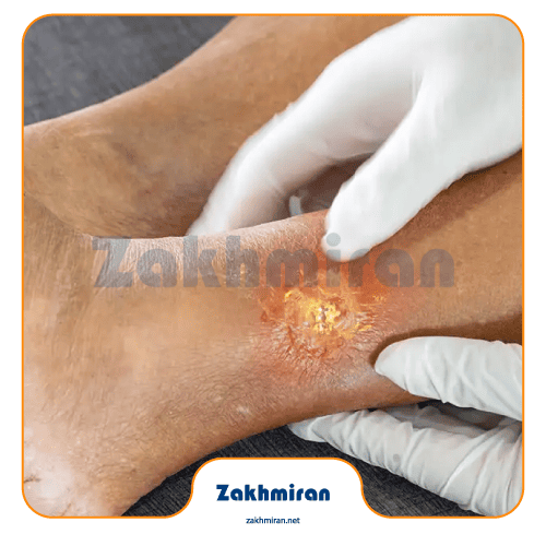 زخم پای دیابتی چیست؟